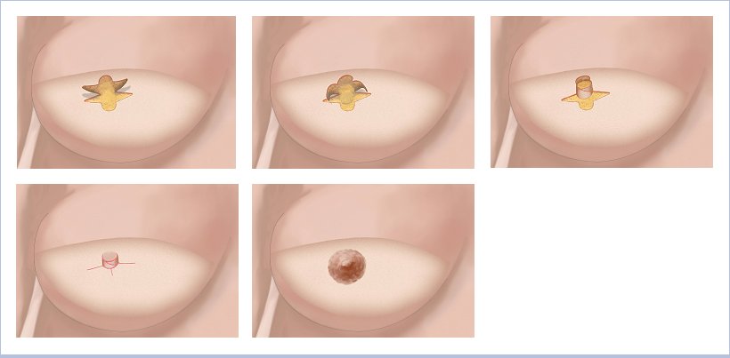 Nipple reconstruction