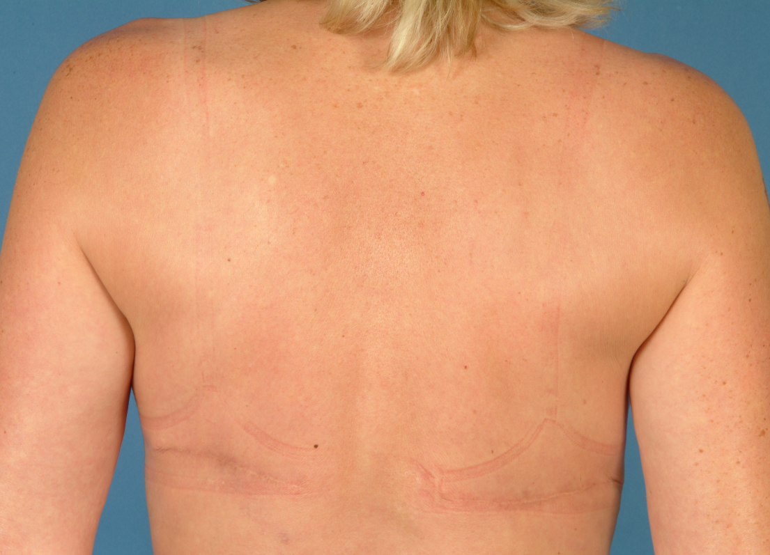 Rekonstruktion mit Latissimus Dorsi (Eigengewebe vom Rücken) und Implantat – Entnahmestelle am Rücken
