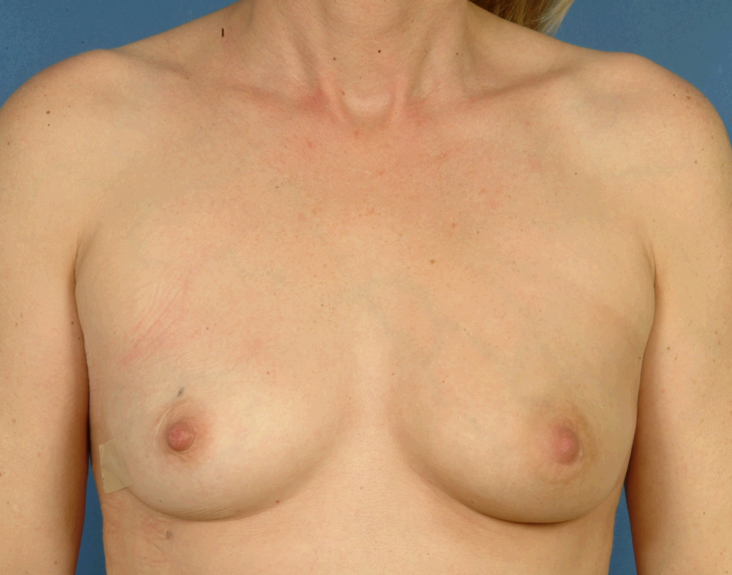 Skin-sparing mastectomy and immediate reconstruction with latissimus dorsi (tissue from the back) and implant