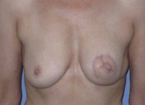 Skin-sparing mastectomy and immediate reconstruction with TMG (tissue from the groin)