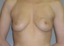 Skin-sparing mastectomy and immediate reconstruction with TMG (tissue from the groin)