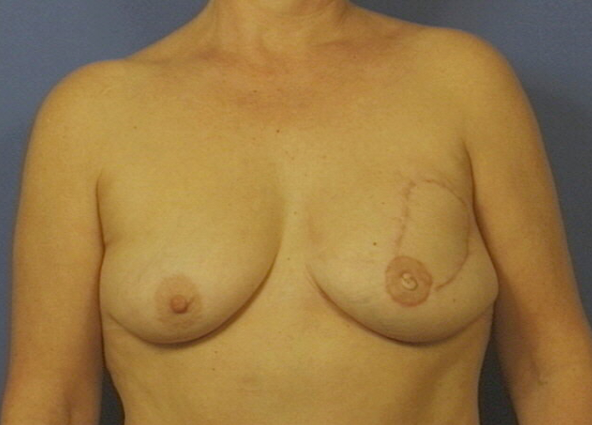 Skin-sparing mastectomy and immediate reconstruction with DIEP (tissue from the abdomen)